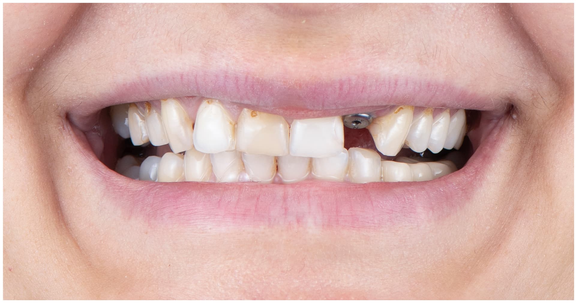 Hvordan kan tannimplantat redde kjevehelsen – og hva du bør gjøre